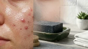 A photorealistic composite close-up illustration showing a split view of skin texture: on the left, highly reflective oily skin with visible acne and large pores; on the right, matte, clear, and refined skin after using charcoal soap.