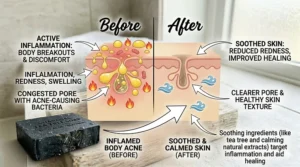 Visual representation of tea tree soap reducing redness and swelling on active body acne breakouts.